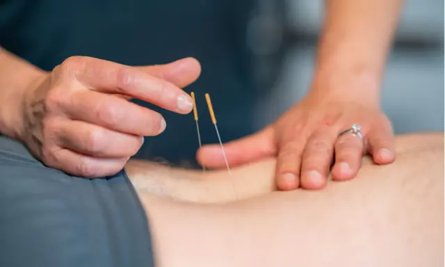 Terapeuta wykonuje suche igłowanie blizny, delikatnie wprowadzając cienkie igły w skórę pacjenta.
