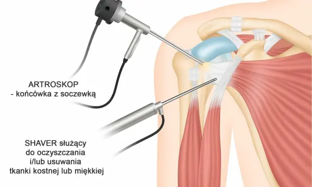 Artroskopia barku: artroskop i shaver pracują w okolicy mięśnia piersiowego mniejszego, oczyszczając tkanki.