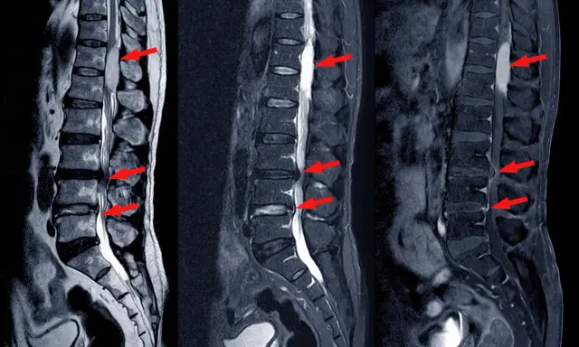 Obrazowanie MRI kręgosłupa lędźwiowego z widoczną dyskopatią, zaznaczoną czerwonymi strzałkami.