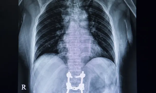 RTG klatki piersiowej z widocznymi implantami stabilizującymi kręgosłup lędźwiowy po operacji.
