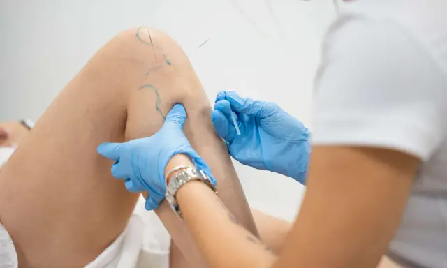 Igłoterapia kolana: specjalista w niebieskich rękawiczkach aplikuje igły. Ile zabiegów potrzeba do ulgi?