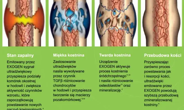Ilustracja pokazuje etapy zrastania się kości: stan zapalny, miękką i twardą kostninę, aż do przebudowy kości.