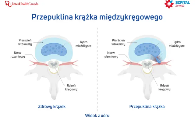 Porównanie zdrowego krążka międzykręgowego z przepukliną krążka, gdzie jądro miażdżyste uciska nerw rdzeniowy.