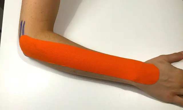 Pomarańczowy plaster kinezjotaping na przedramieniu, wspierający leczenie łokcia tenisisty. Fizjoterapia w działaniu.