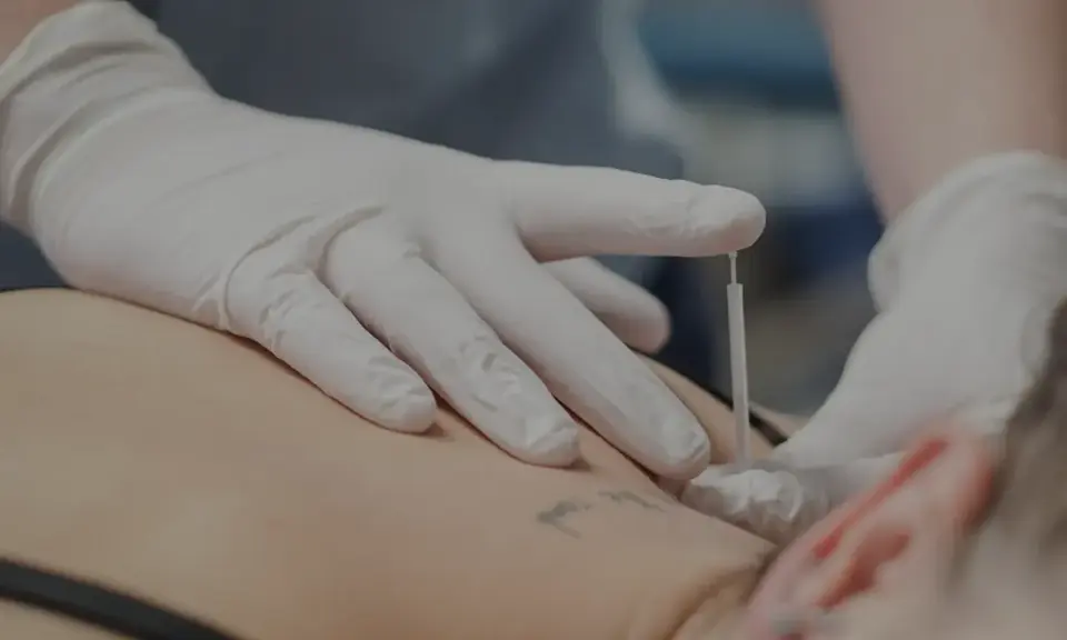 Dłoń w białej rękawiczce wykonuje zabieg suchego igłowania na plecach pacjenta.
