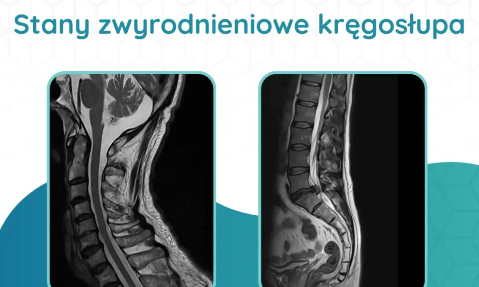 Dwa obrazy rezonansu magnetycznego kręgosłupa, ukazujące zmiany zwyrodnieniowe odcinka szyjnego i lędźwiowego.