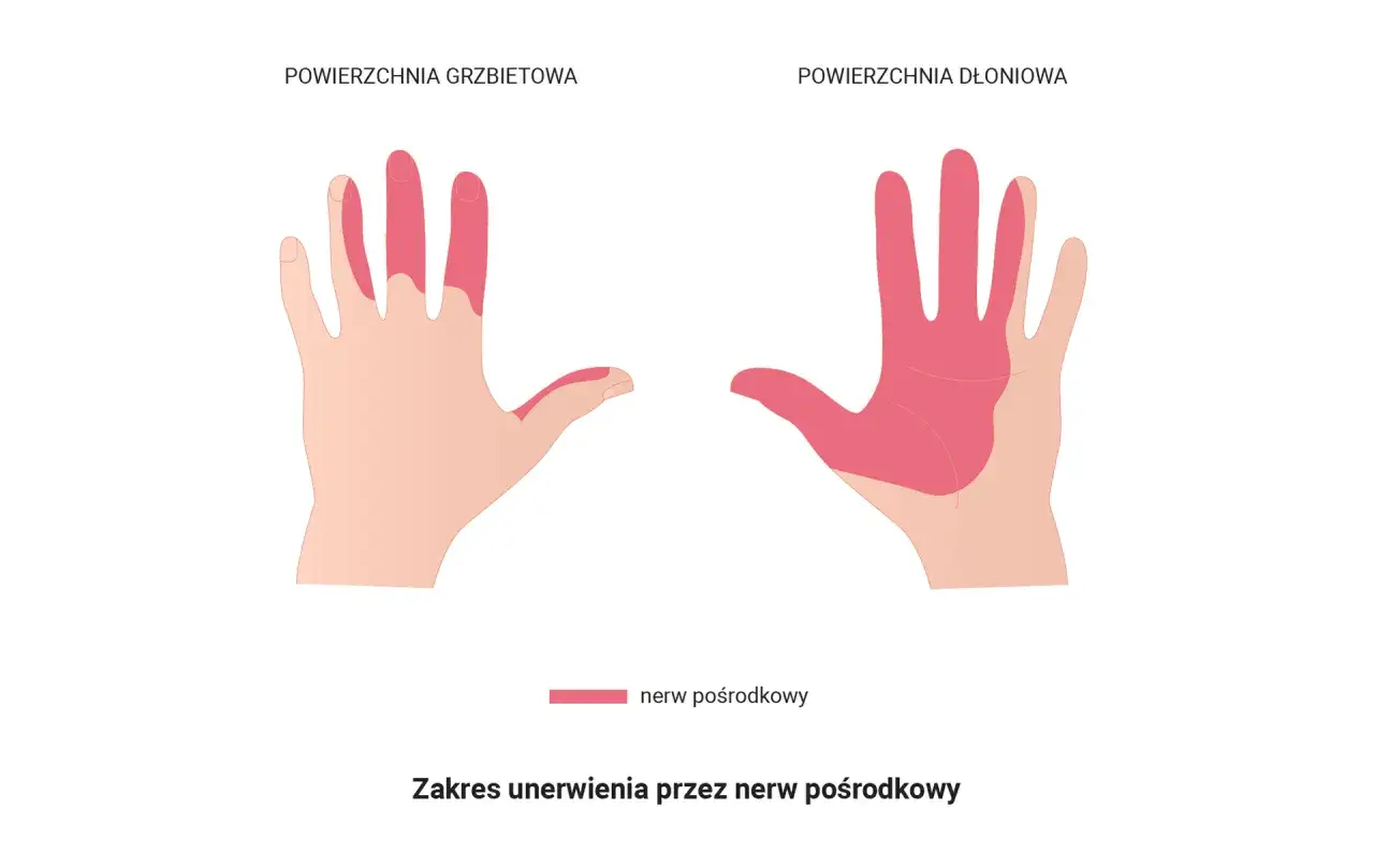 Ilustracja pokazuje unerwienie dłoni przez nerw pośrodkowy. Czerwone obszary wskazują, gdzie występują fascykulacje mięśni.