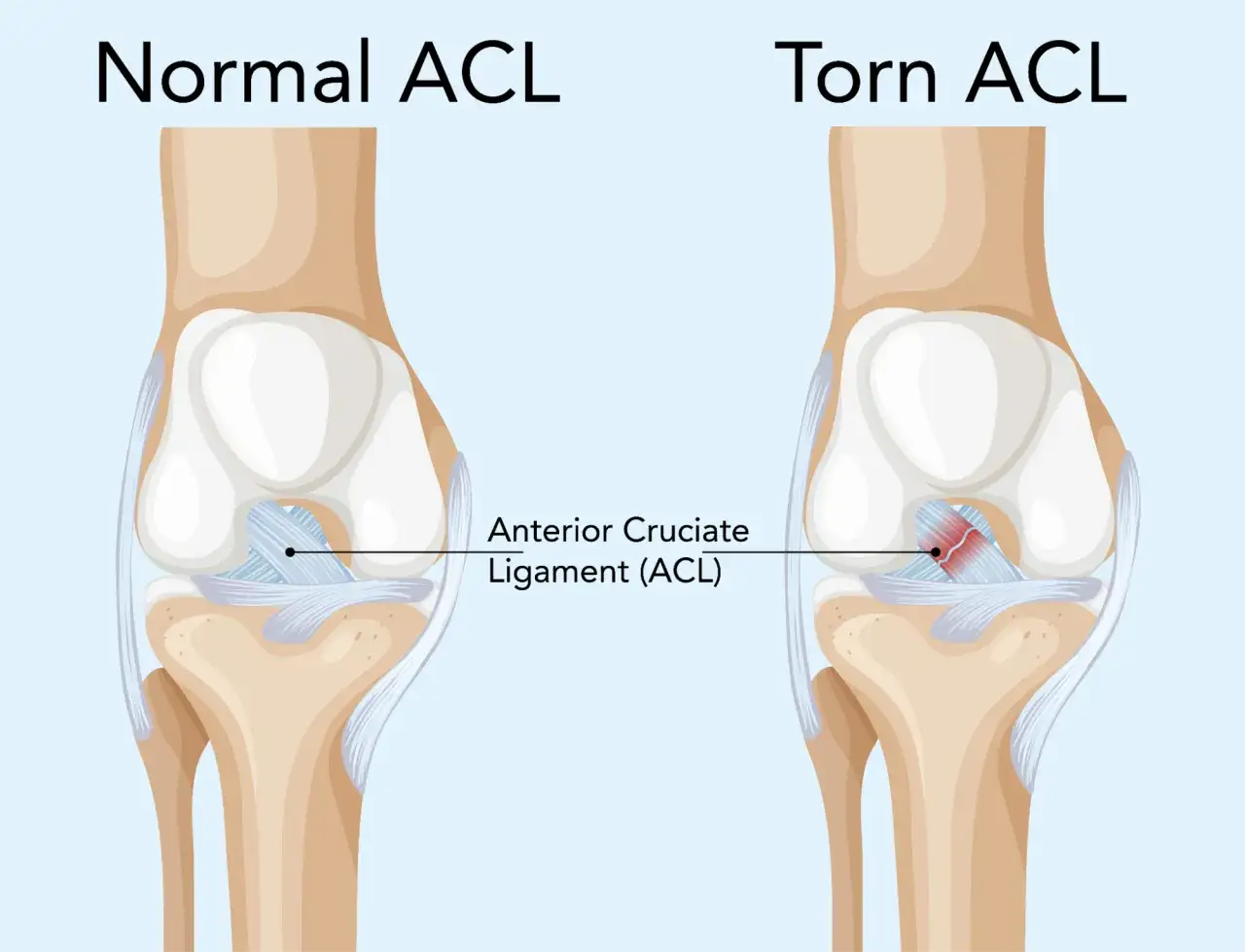 Por&oacute;wnanie zdrowego więzadła krzyżowego przedniego (ACL) z zerwanym ACL.