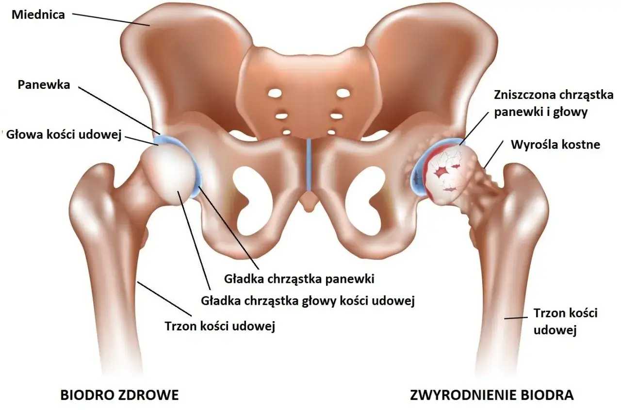 Por&oacute;wnanie zdrowego biodra z biodrem ze zniszczoną chrząstką i wyroślami kostnymi, ilustrujące problem rwy biodrowej.