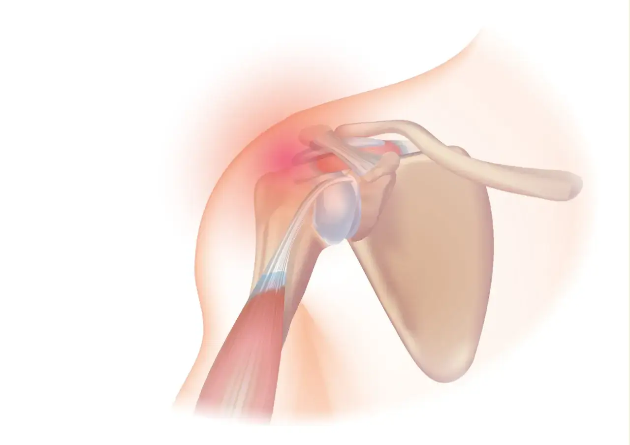 Ilustracja anatomiczna przedstawiająca b&oacute;l i zapalenie w obrębie stawu barkowego, wskazujące na uraz barku.