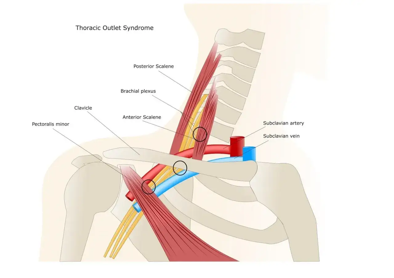 Ilustracja anatomiczna przedstawiająca zespół szyjno barkowy, z zaznaczonym splotem ramiennym, tętnicą i żyłą podobojczykową.